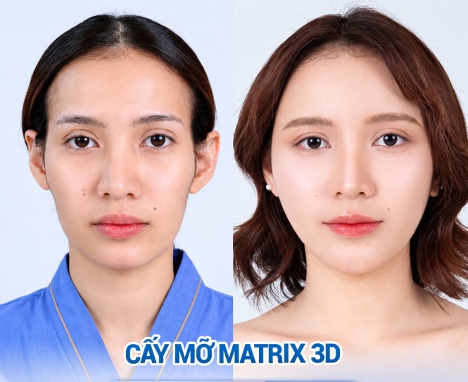Hình ảnh so sánh trước và sau cấy mỡ Matrix 3D, minh họa khả năng bổ sung thể tích cho những vùng gương mặt thiếu đầy đặn. Khách hàng cần được bác sĩ đánh giá cấu trúc khuôn mặt và chỉ định lượng mỡ phù hợp trước khi thực hiện.