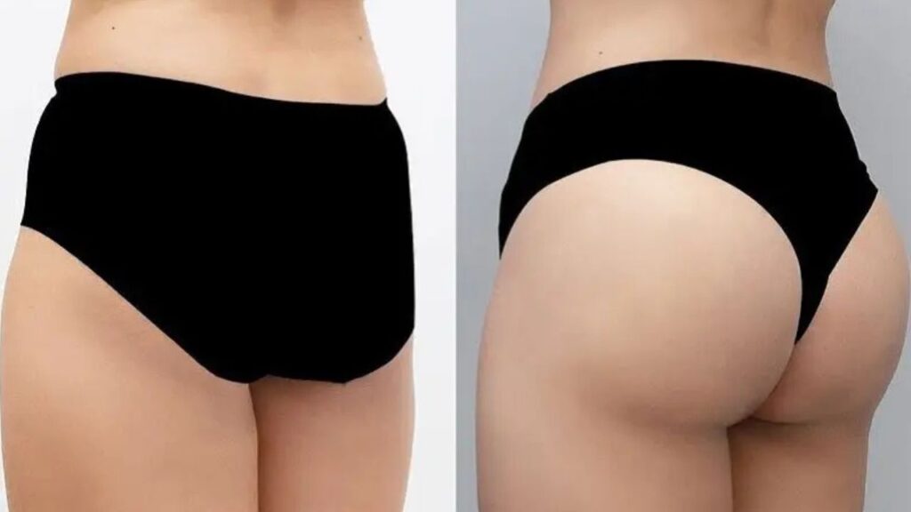 Cấy mỡ mông giá bao nhiêu? Bảng giá và chính sách trả góp mới nhất