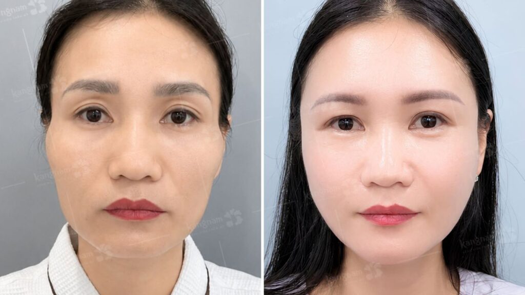 Cấy mỡ mặt giá bao nhiêu năm 2026? Bảng giá theo vùng và trọn gói