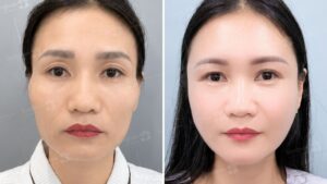 Cấy mỡ mặt giá bao nhiêu năm 2026? Bảng giá theo vùng và trọn gói