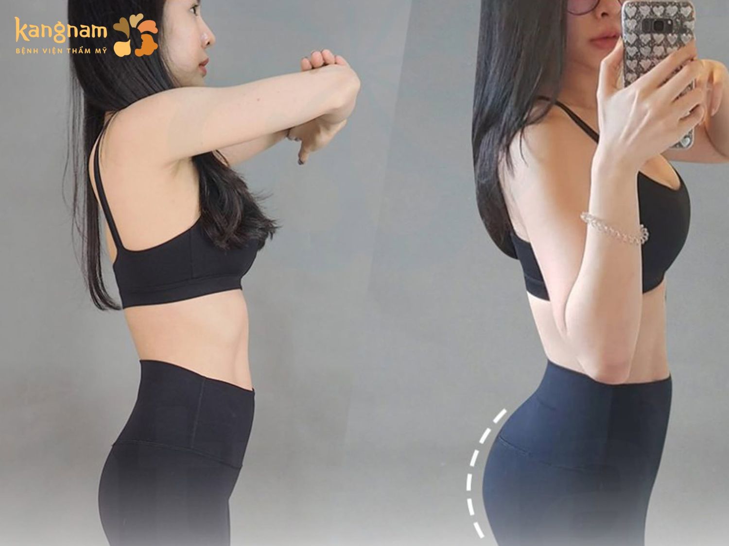 Hình ảnh so sánh trước và sau cấy mỡ mông tại Kangnam cho thấy vòng 3 đầy đặn hơn, góp phần cải thiện đường cong cơ thể và tạo sự cân đối giữa eo, hông và mông.