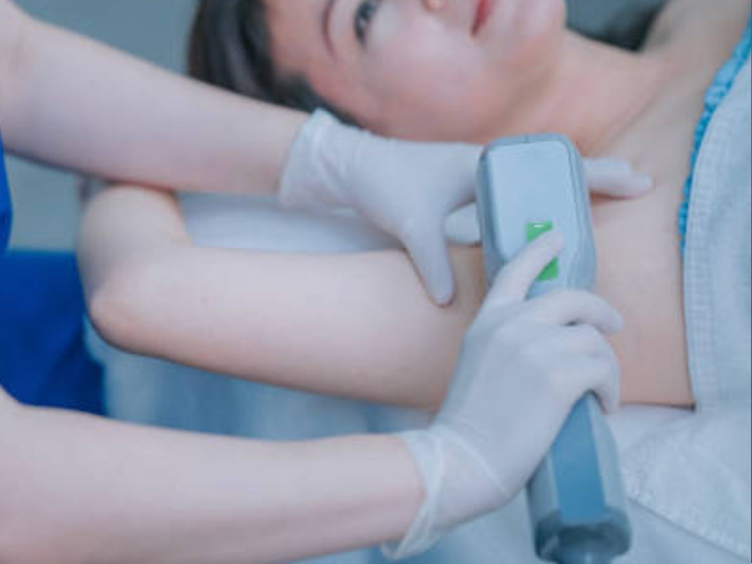 Bác sĩ chiếu tia laser trị thâm nách cho khách