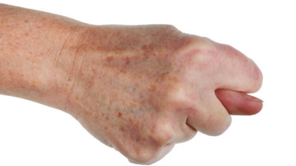 Chi phí xóa đồi mồi ở mặt và mu bàn tay bao nhiêu?