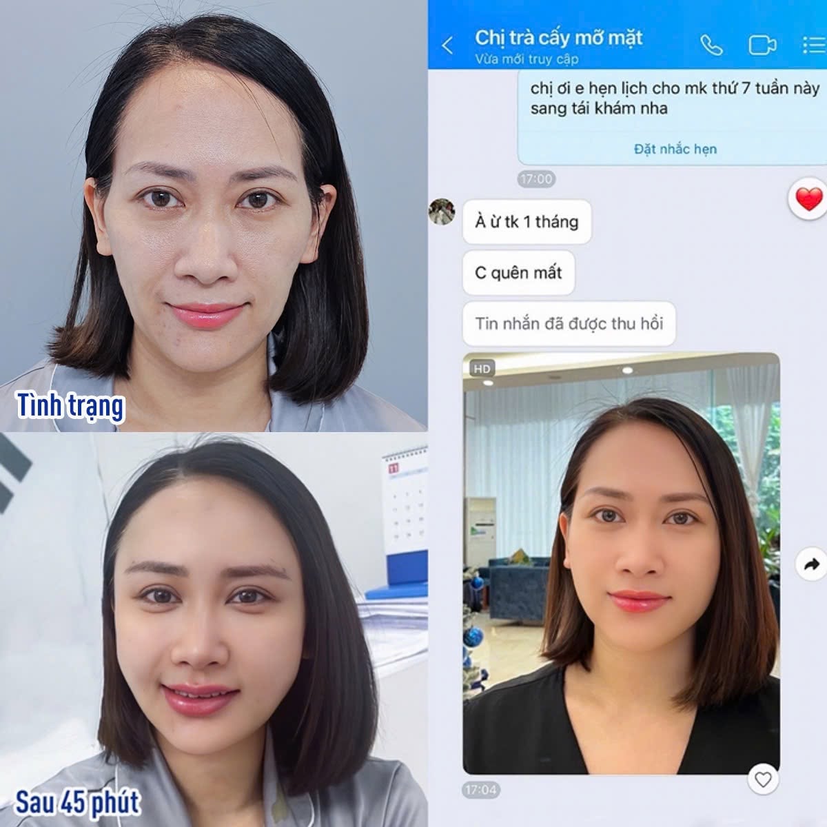 Hình ảnh khách hàng sau cấy mỡ mặt cho thấy sự thay đổi ban đầu về độ đầy đặn khuôn mặt. Kết quả cần được đánh giá thêm sau khi mô hồi phục và ổn định.