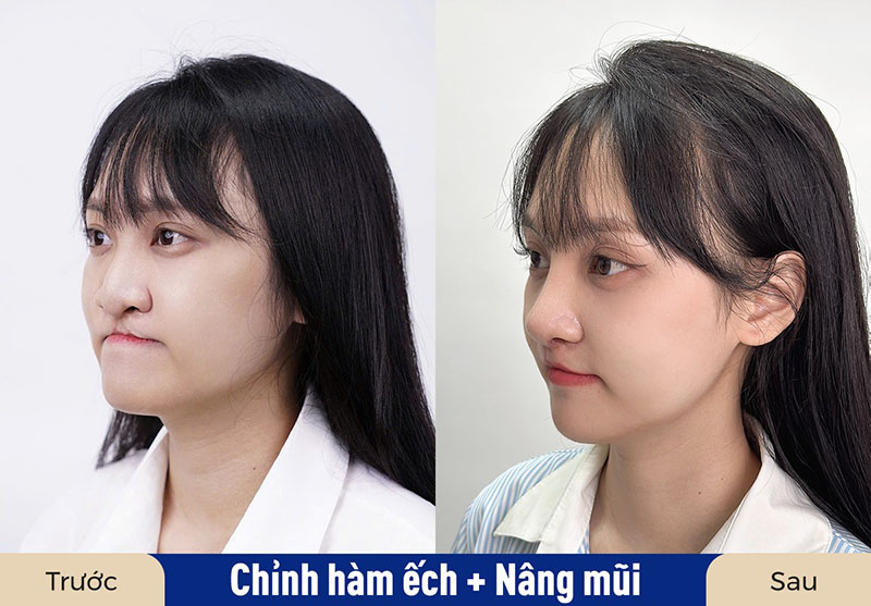 Minh Xuân trước và sau phẫu thuật