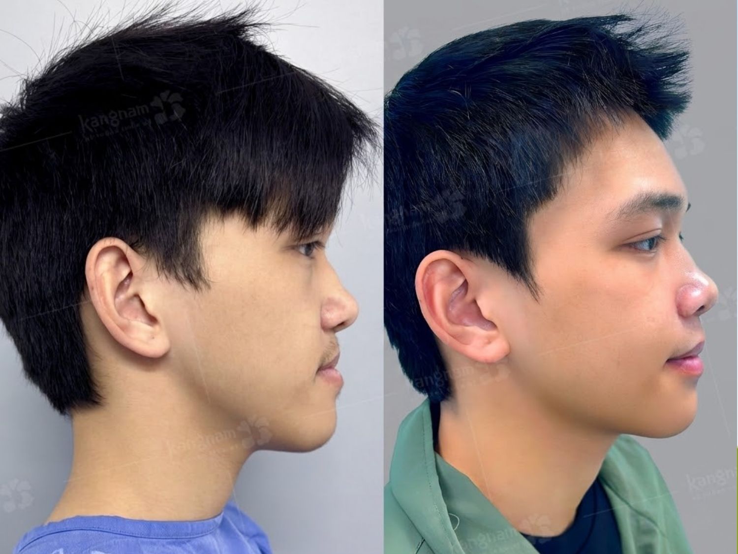ảnh trước và sau khách chỉnh hàm móm tại Kangnam