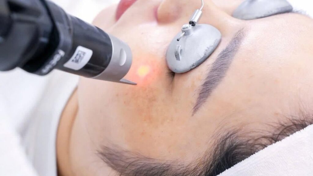 Chọn cơ sở trị tàn nhang: 6 tiêu chí và cách kiểm tra máy laser chính hãng