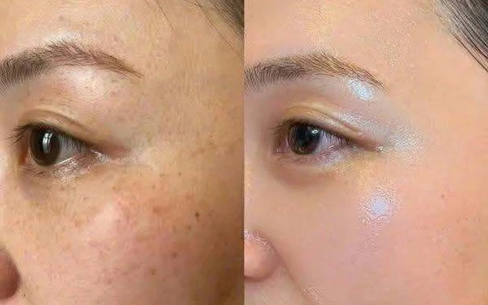 Cần chú ý những hình ảnh trị nám trên mạng
