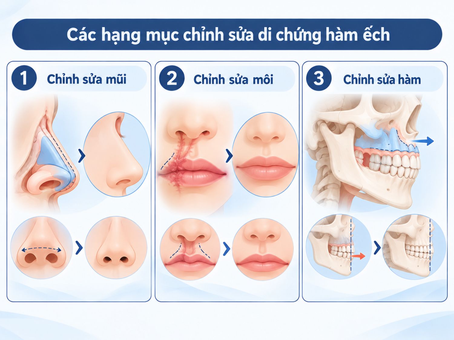 ảnh mô tả Các hạng mục chỉnh sửa di chứng hàm ếch