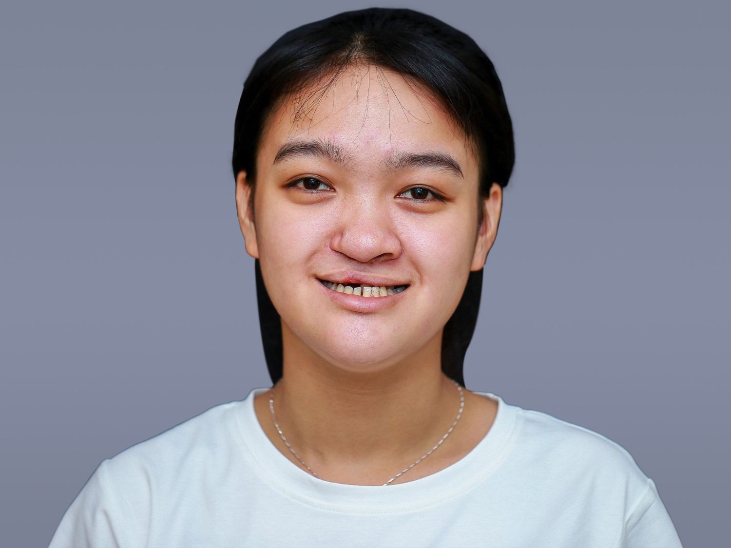 di chứng hàm ếch