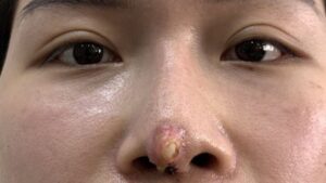 Di chứng nâng mũi lâu năm: Những biến chứng có thể gặp và cách xử lý