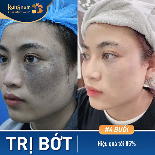 Hết tới 86% bớt sau 4 buổi