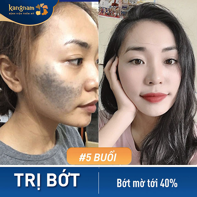 Bớt xanh đậm màu và lan nhiều vị trí, sau 5 buổi biến mất hoàn toàn