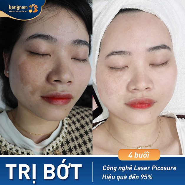 giảm bớt rõ rệt sau 4 buổi