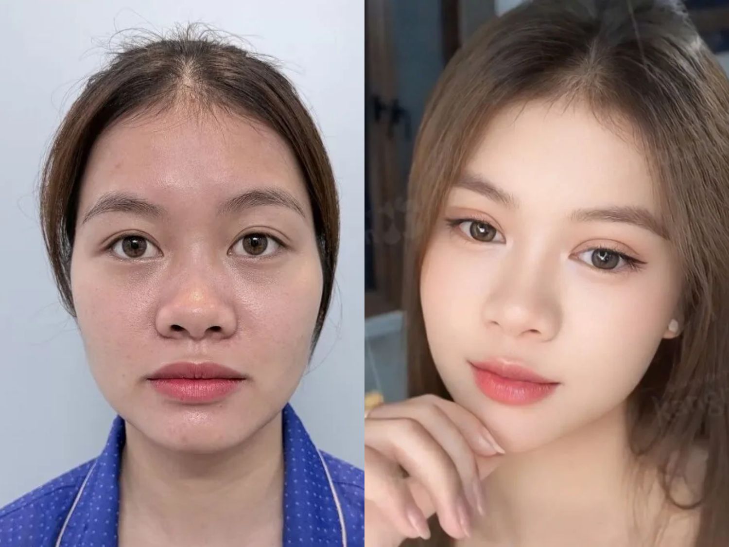 Khách hàng Diệu Yến gặp tình trạng mắt mí lót, hai bên không đều . Sau cắt mí tại Kangnam sở hữu nếp mí tự nhiên