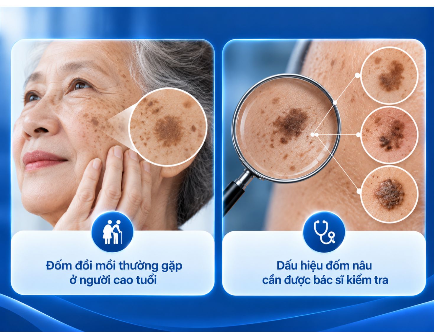 Đốm nâu ở người cao tuổi thường liên quan đến lão hóa da và tác động của ánh nắng. Tuy nhiên, những đốm thay đổi màu sắc, kích thước hoặc hình dạng bất thường cần được bác sĩ kiểm tra để xác định nguyên nhân.