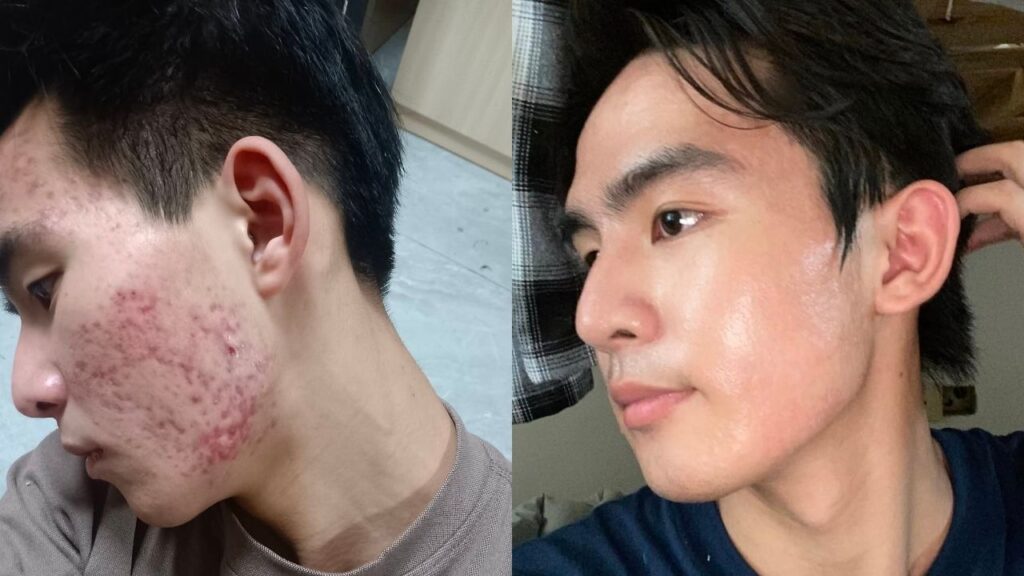 Liệu trình trị mụn 10 buổi giá bao nhiêu? Có cần điều trị đủ 10 buổi?