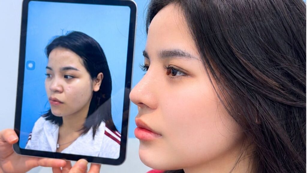 Tổng chi phí nâng mũi trọn gói là bao nhiêu? Đã gồm thuốc và tái khám chưa