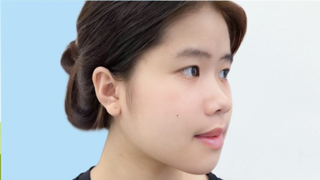 Gọt hàm, trượt cằm có cần làm ở bệnh viện không hay phòng khám cũng được?