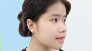 Gọt hàm, trượt cằm có cần làm ở bệnh viện không hay phòng khám cũng được?