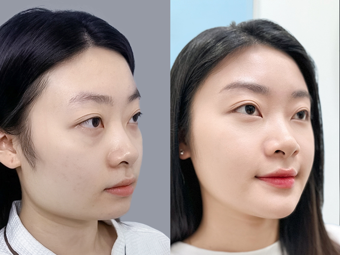 Ảnh trước và sau của khách gọt hàm