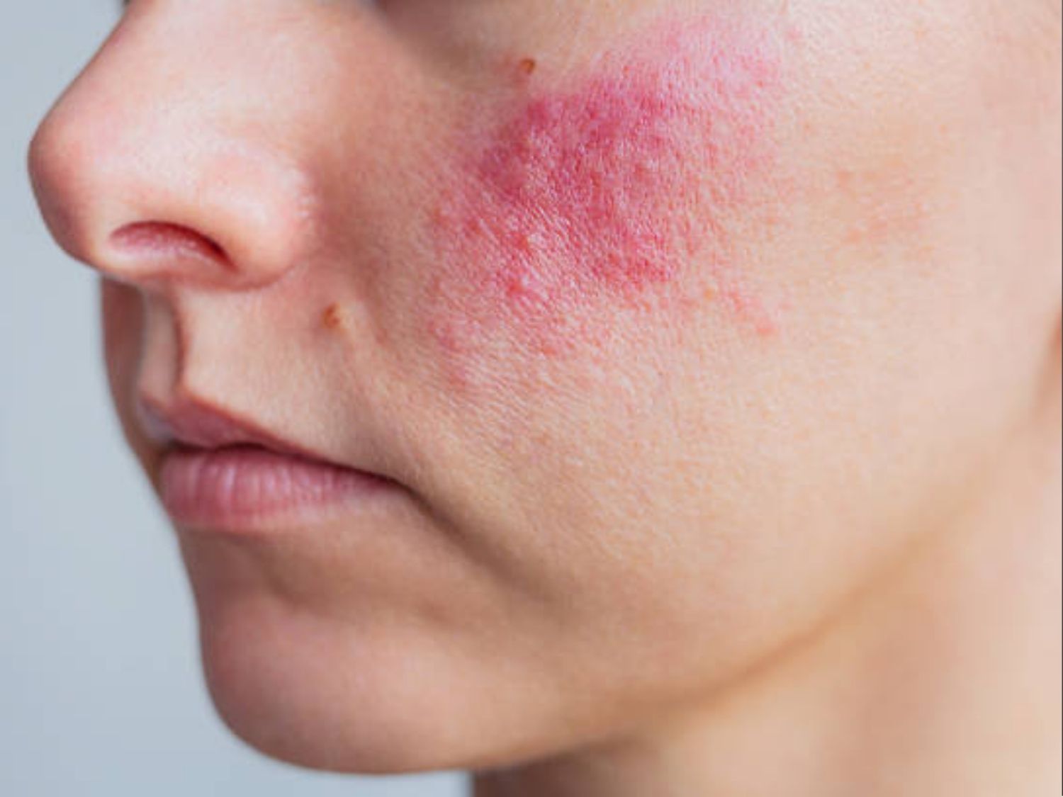 tình trạng da Bỏng nhiệt và tăng sắc tố