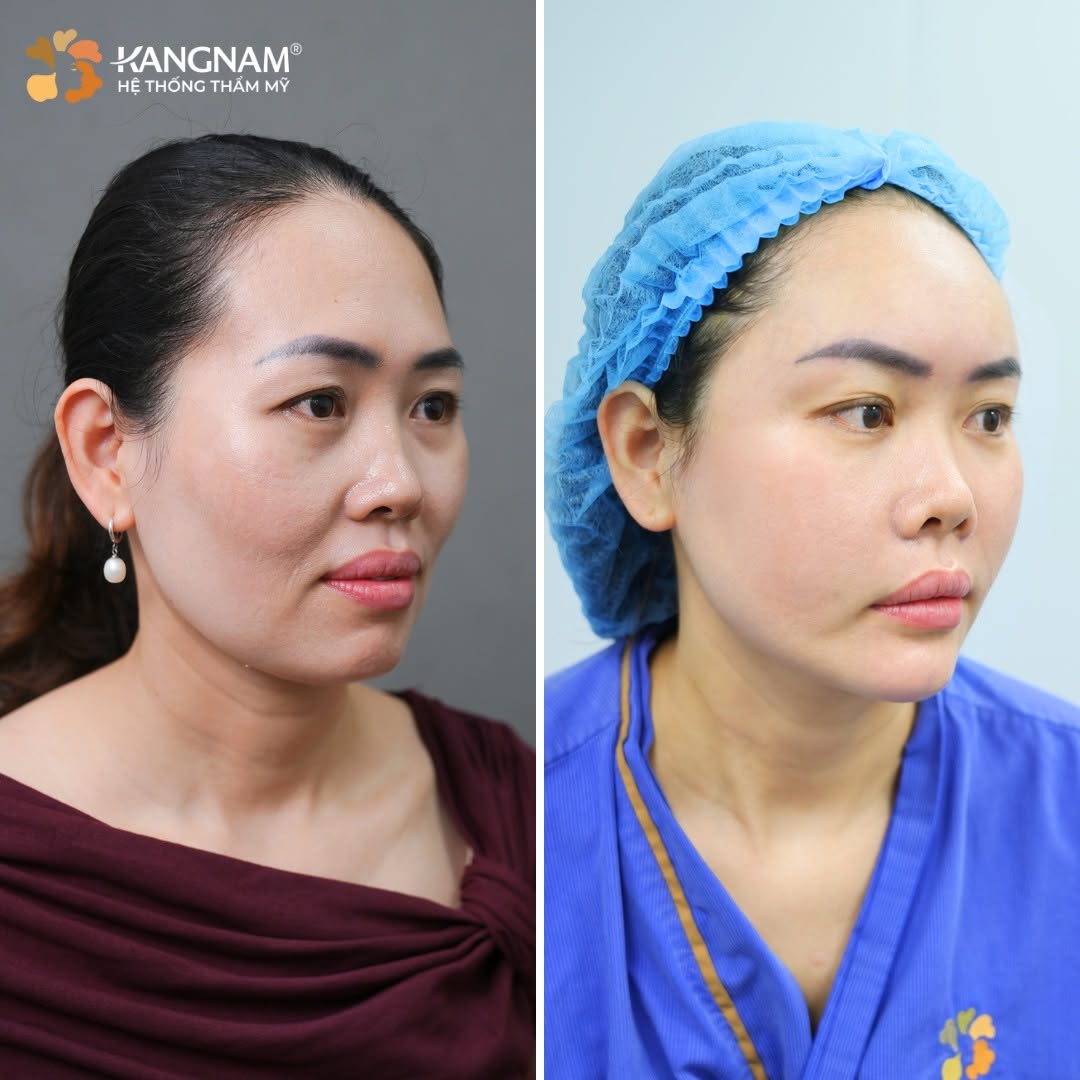 Cấy mỡ tại địa chỉ thẩm mỹ uy tín để tránh biến chứng xảy ra