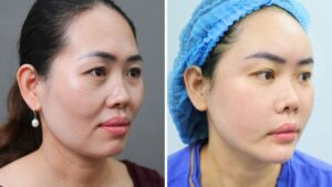 Hút mỡ kết hợp cấy mỡ giá bao nhiêu? Có rẻ hơn làm riêng?