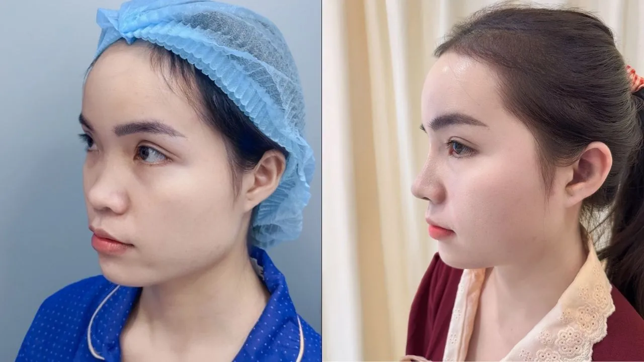 Kim Hạnh khắc phục sống mũi thấp, cánh mũi to bè tại Kangnam