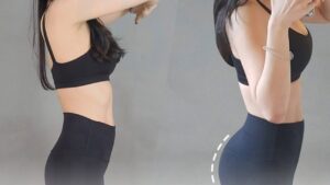 Kangnam có cấy mỡ mông không? Chi phí, quy trình và hiệu quả duy trì