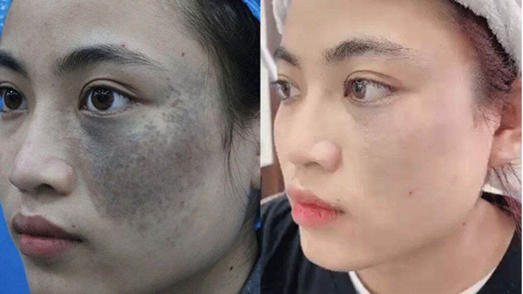 Kangnam có ảnh trước sau điều trị bớt sắc tố không?