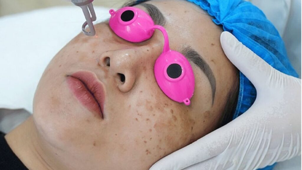Kangnam có phác đồ riêng điều trị nám sau sinh không?