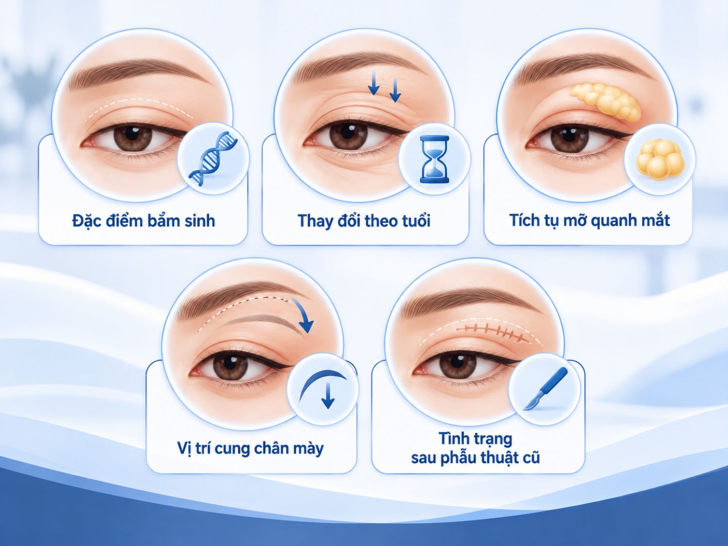 ảnh mô tả yếu tố có thể khiến vùng mí trên xuất hiện da dư