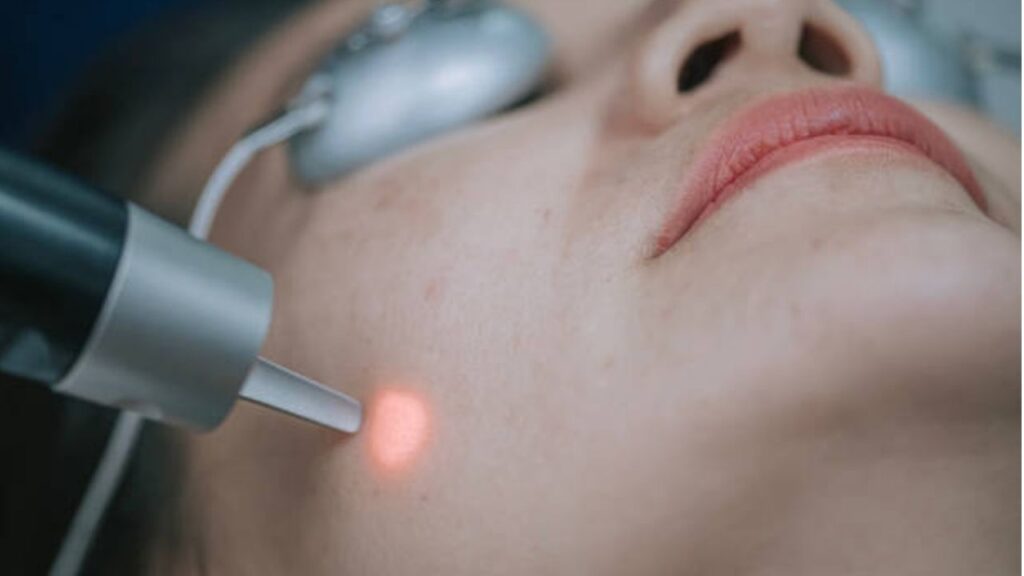 Kangnam trị tàn nhang bằng công nghệ gì, có phải máy laser đời mới không?
