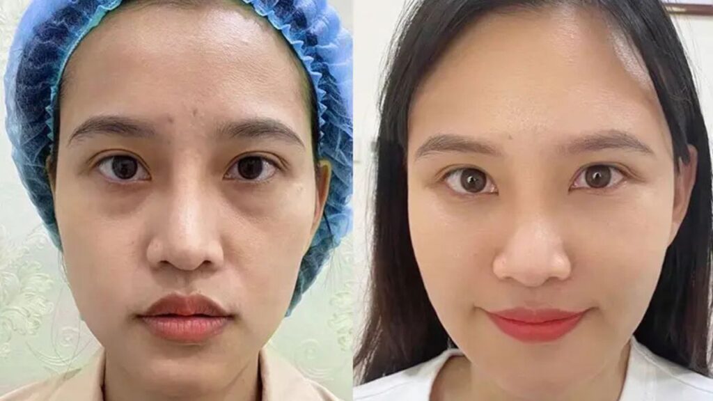 Kangnam sửa cấy mỡ hỏng, lấp lõm sau hút mỡ tại nơi khác không?