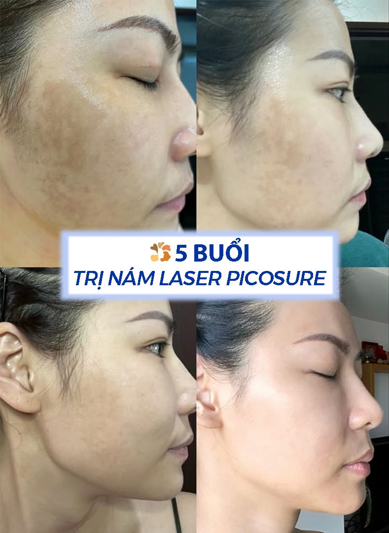 Khách hàng sau khi trị nám bằng laser 5 buổi, làn da tươi sáng, mờ nám