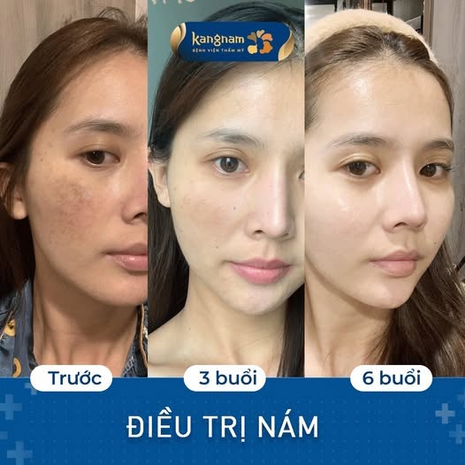 Sự thay đổi tình trạng nám của khách hàng tại Kangnam qua các mốc trước điều trị, sau 3 buổi và 6 buổi, cho thấy các vùng sắc tố có dấu hiệu cải thiện.