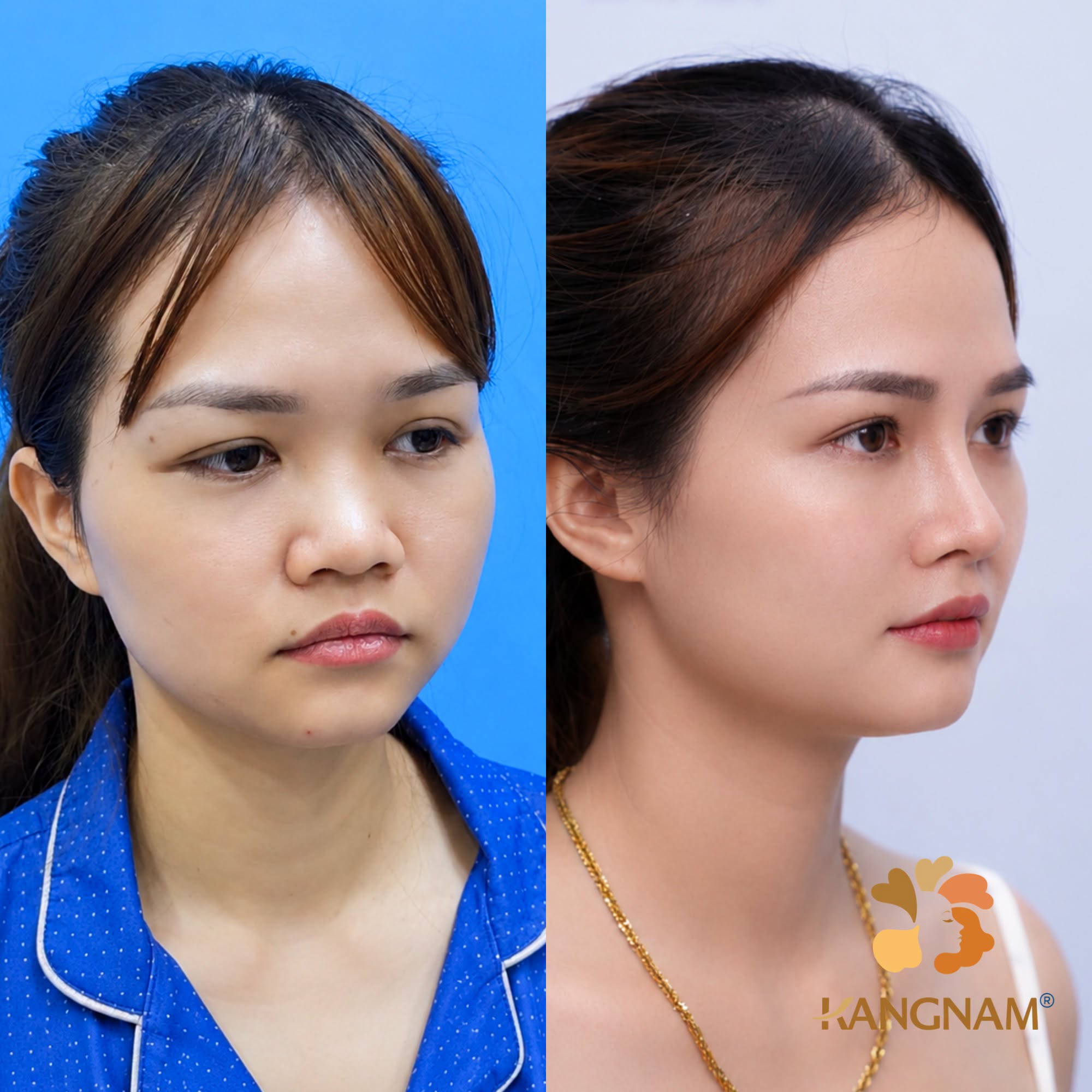 khách nâng mũi cấu trúc sở hữu dáng mũi bền đẹp
