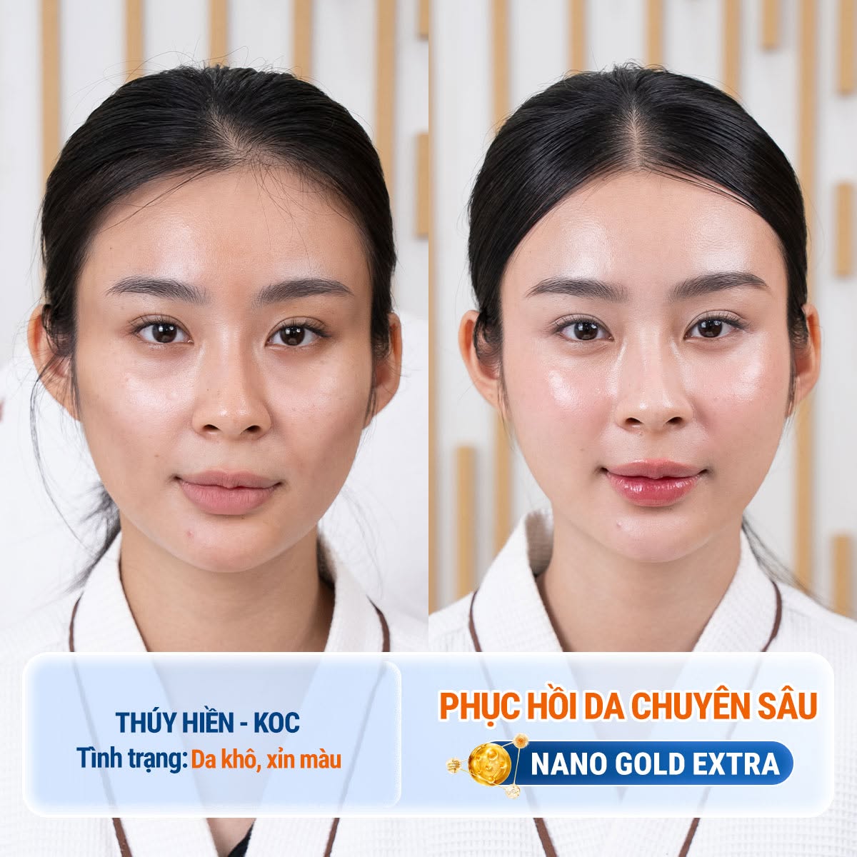 Hình ảnh trước và sau cho thấy sự thay đổi về độ sáng và bề mặt da sau liệu trình. Hiệu quả thực tế có thể khác nhau tùy tình trạng mỗi người.
