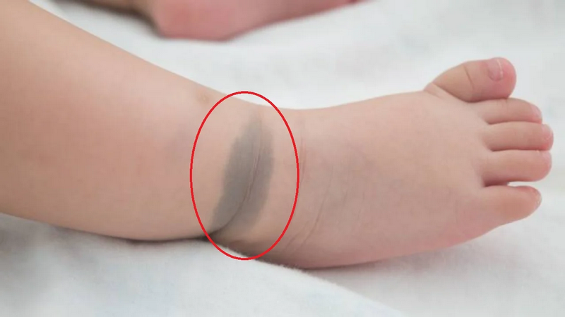 Bớt sắc tố bẩm sinh có thể xuất hiện ở chân, tay hoặc nhiều vị trí trên cơ thể. Trẻ cần được thăm khám để xác định loại bớt và hướng theo dõi phù hợp.