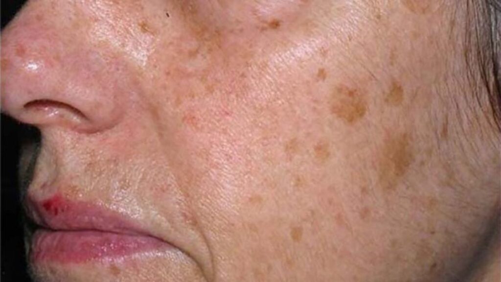 Khám đốm nâu người già ở đâu? Cách chọn nơi khám kỹ, thuận tiện cho bố mẹ lớn tuổi