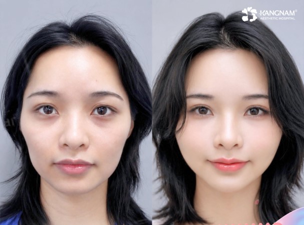 Khánh Huyền khắc phục được tình trạng má hóp, lõm