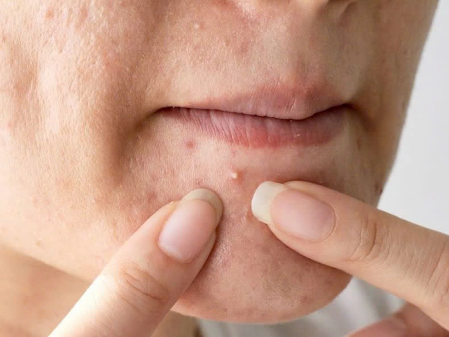 Tự ý nặn mụn bằng tay có thể khiến da bị tổn thương, tăng nguy cơ viêm nhiễm và để lại thâm, sẹo. Nên hạn chế tác động lên mụn, chăm sóc da đúng cách và thăm khám bác sĩ da liễu khi mụn viêm kéo dài.