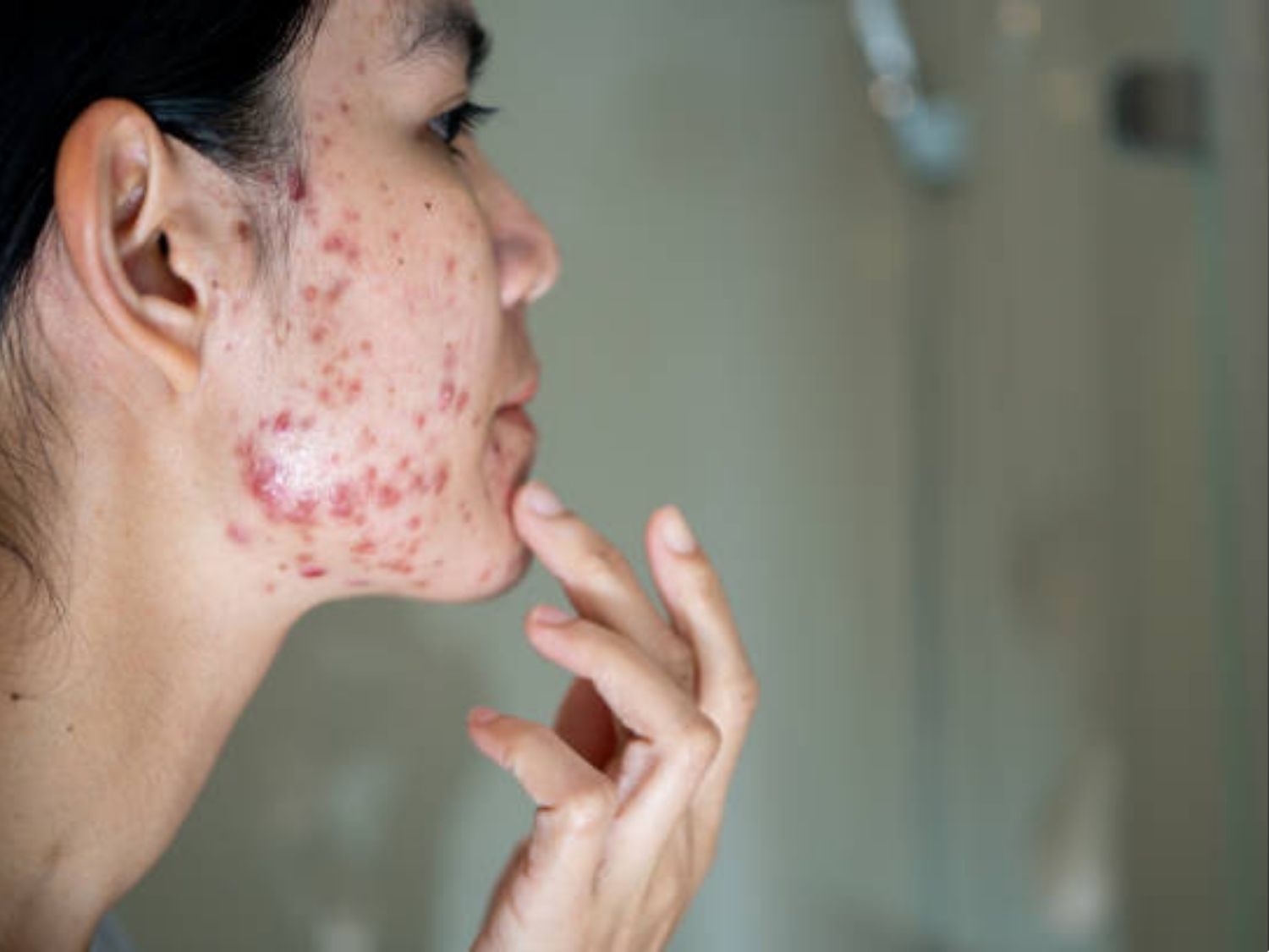 Tình trạng mụn nặng hơn do khách điều trị tại cơ sở kém uy tín