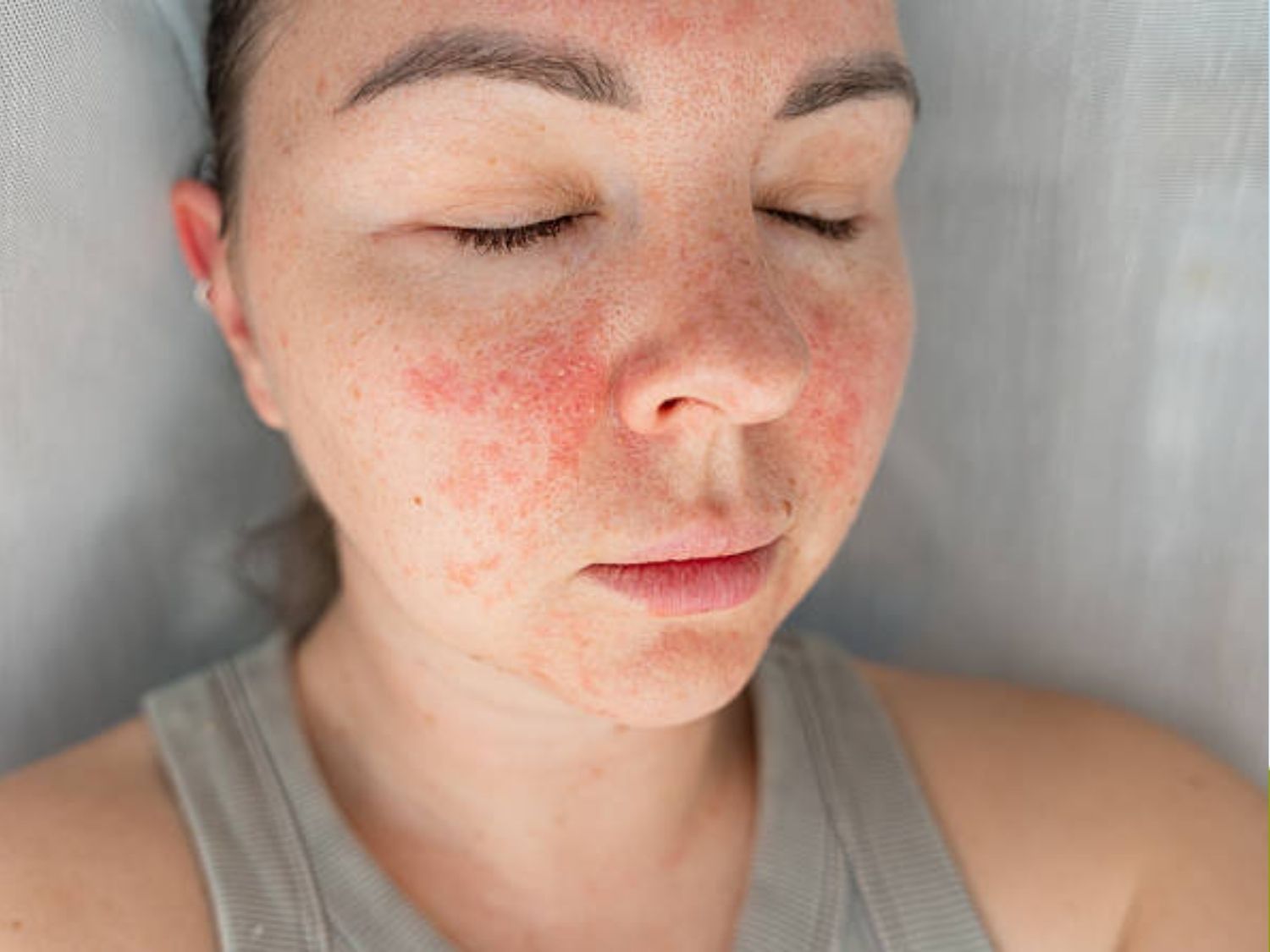 Năng lượng nhiệt phát ra không đều khiến da bị bỏng và rộp đỏ