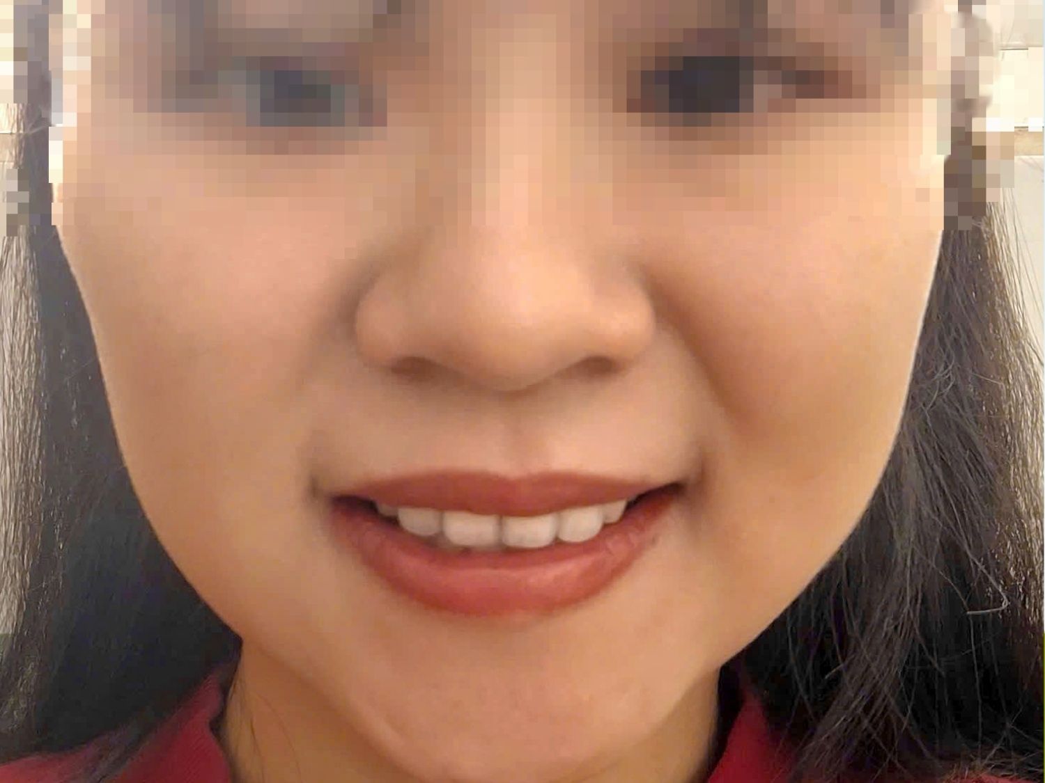 mặt đơ sau khi tiêm botox quá nhiều và sai kỹ thuật