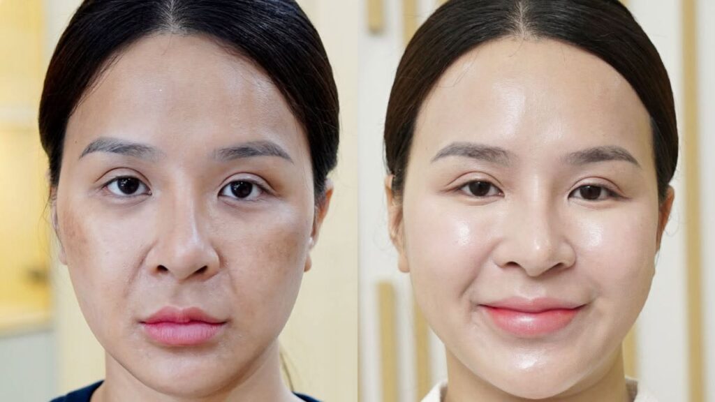 Liệu trình phục hồi da giá bao nhiêu? Chi phí và thời gian thực hiện