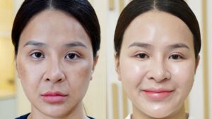 Liệu trình phục hồi da giá bao nhiêu? Chi phí và thời gian thực hiện