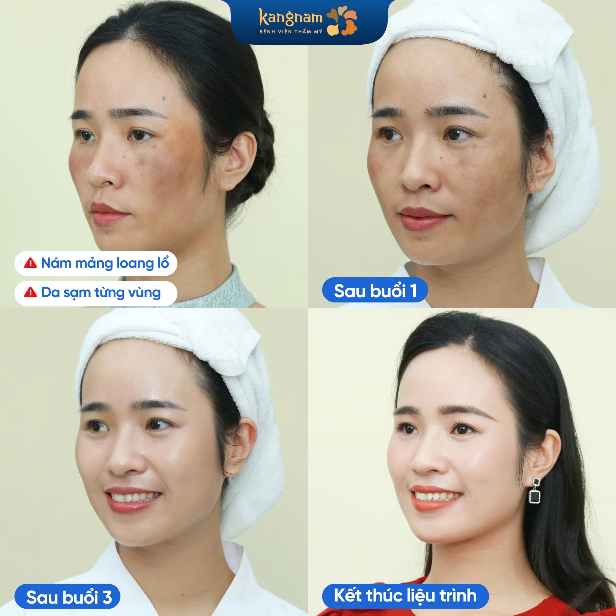 Tùy vào từng tình trạng da, loại nám mà sau mỗi buổi điều trị sẽ có sự thay đổi khác nhau