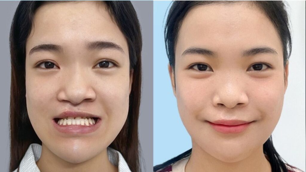 Mặt lệch do xương nên tìm bác sĩ nào? Có cần chỉnh nha